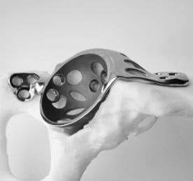 Bespoke the word – 3D-printed implants
