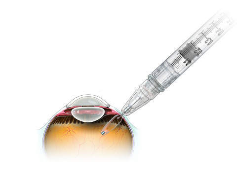 Genentech’s eye implant shows significant effect in phase II LADDER study