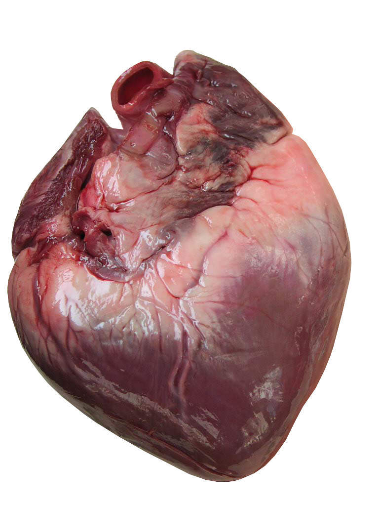 CARMAT confirms first heart transplant of patient earlier implanted with artificial heart