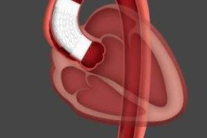 Gore unveils first patient implant endovascular stent graft for ascending aorta