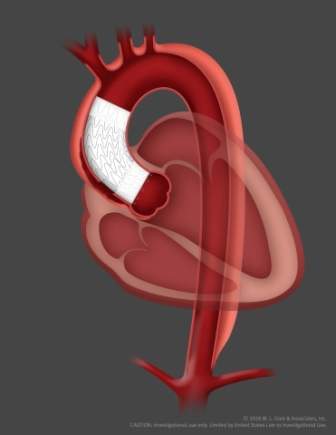 Gore unveils first patient implant endovascular stent graft for ascending aorta