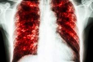 Study shows Immunovia`s blood-based biomarker array offers highly accurate diagnosis of NSCLC