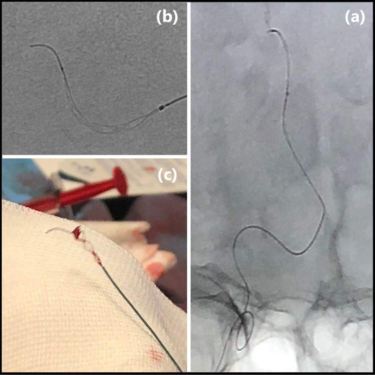 Rapid Medical secures CE Mark for Tigertriever 13 stent retriever