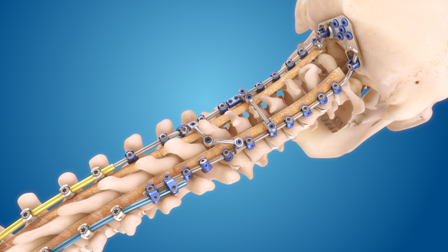 Medtronic introduces Infinity OCT spinal system in US
