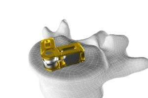 CoreLink Surgical launches articulating expandable posterior lumbar system