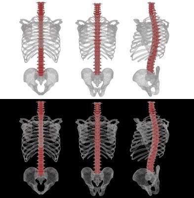 Amedica completes spine business sale to CTL Medical