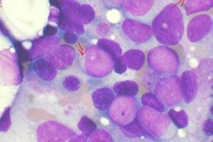 Invivoscribe submits LeukoStrat CDx FLT3 assay in US, Japan as companion diagnostic for quizartinib