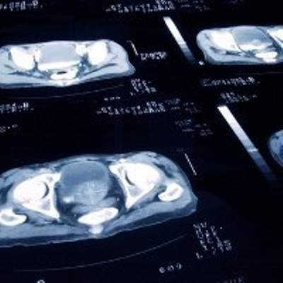 UK’s NICE recommends non-invasive MRI scan for prostate cancer
