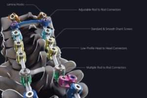 Nexxt Spine introduces Saxxony posterior cervical thoracic spine system