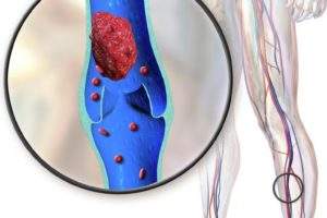 First patient treated in Vetex thrombectomy catheter study