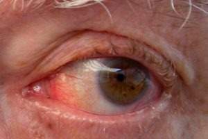 Glaucoma Awareness Month: New techs and trends for eye condition treatment