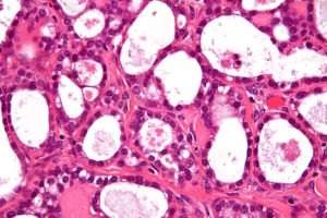 New test scans tumour cells shapes to identify women with ovarian cancer