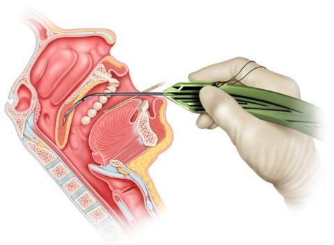 Cook Medical, Zelegent secure FDA clearance for snoring device