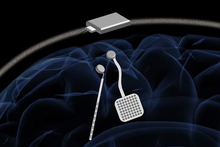 Wireless pacemaker for brain could be new standard treatment for neurological disorders