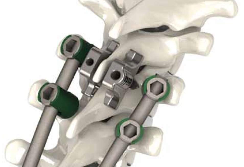 Southern Spine announces three new StabiLink Dual Lamina implants