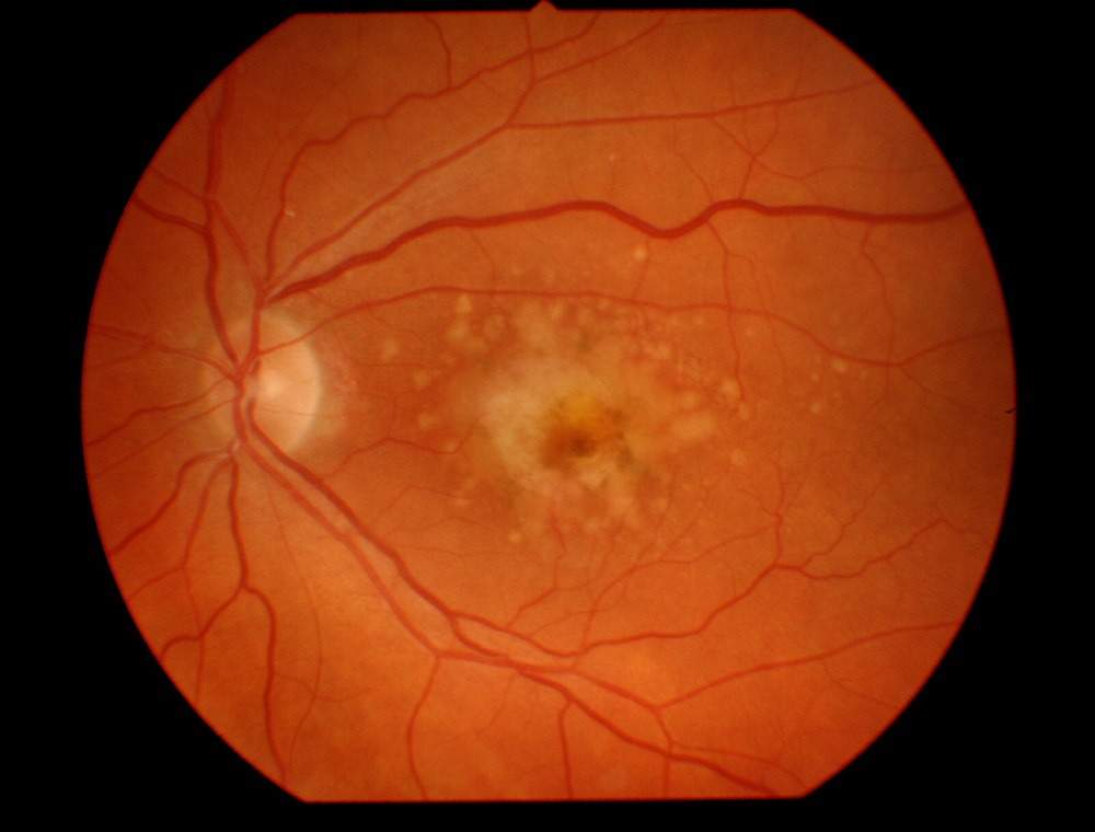 Diabetic Retinopathy