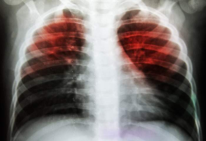 New rapid blood test for tuberculosis could speed up diagnosis