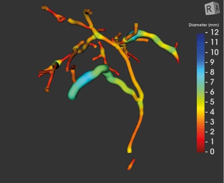 Perspectum secures FDA clearance for first quantitative AI tool for biliary disease