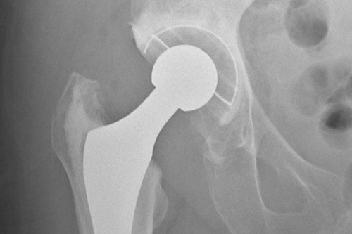 Hip, Knee replacement