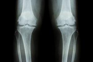 IlluminOss Medical introduces bone stabilization system in US
