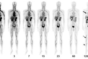 PET/CT imaging agent shows promise for safe and effective diagnosis of acute venous thromboembolism