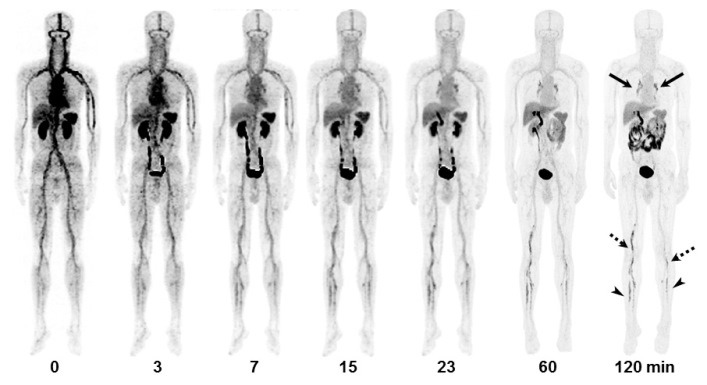 PET/CT imaging agent shows promise for safe and effective diagnosis of acute venous thromboembolism