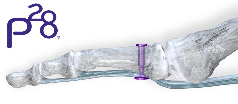 Paragon 28 introduces TenoTac soft tissue fixation system for foot and ankle