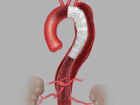 Cook Medical gets FDA approval for aortic dissection device