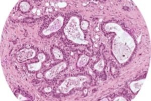 Pancreatic cancer trial in UK achieves patient milestone