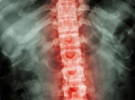 Intralink-Spine goes down under to extend clinical studies