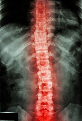 Intralink-Spine goes down under to extend clinical studies