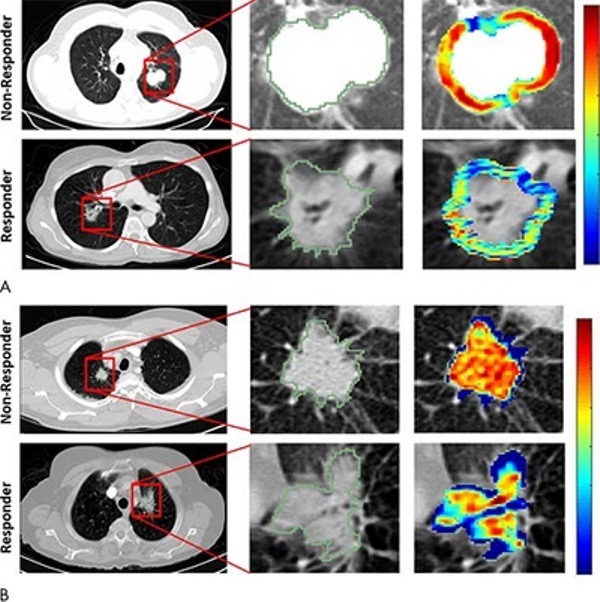 Researchers use radiomics to predict which lung cancer patients will respond to chemotherapy
