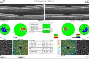 Optovue launches new AngioWellness scan