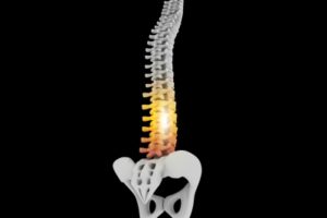 SpineEX announces issuance of US patent for expandable and adjustable lordosis interbody fusion system