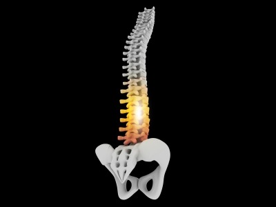 SpineEX announces issuance of US patent for expandable and adjustable lordosis interbody fusion system
