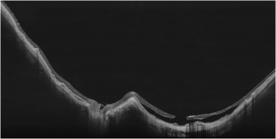 ULTRA-HD-Spotlight-of-a-Myopic-Staphyloma