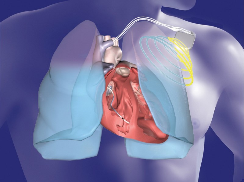 New studies highlight underuse of implantable cardiac devices