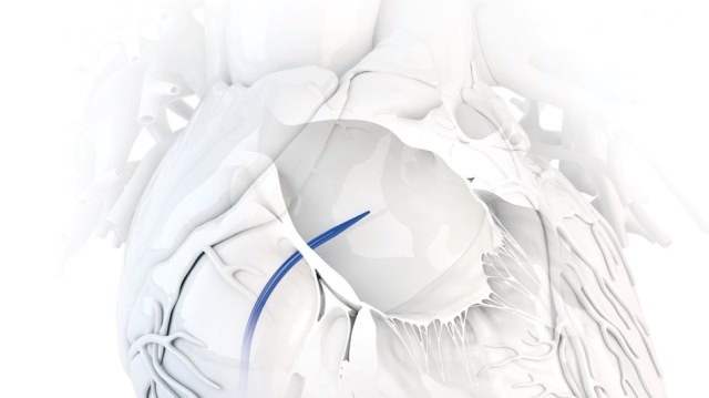 Baylis Medical launches ExpanSure transseptal dilation system in US