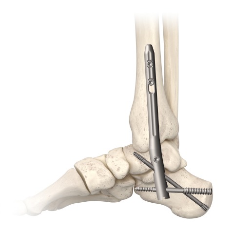In2Bones announces global launch of TriWay TibioTaloCalcaneal nail arthrodesis system
