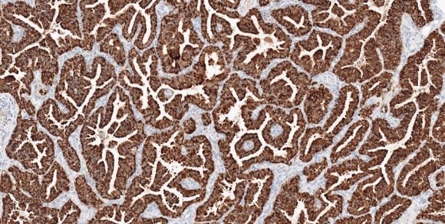 Roche introduces in vitro diagnostic ROS1 IHC assay