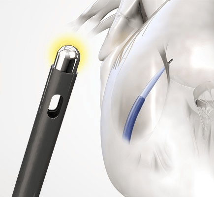 Study links use of Baylis Medical RF transseptal needle to procedural cost-savings