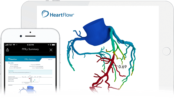 How HeartFlow helps the NHS predict the impact of blockages on blood flow