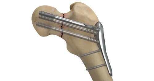 Smith & Nephew introduces new Conquest FN femoral neck fracture system