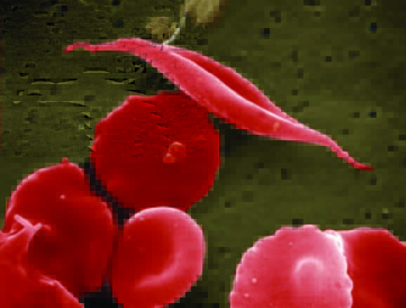 World Sickle Cell Day: Latest medical devices to help treat the genetic condition