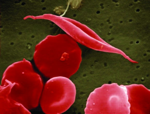 sickle cell