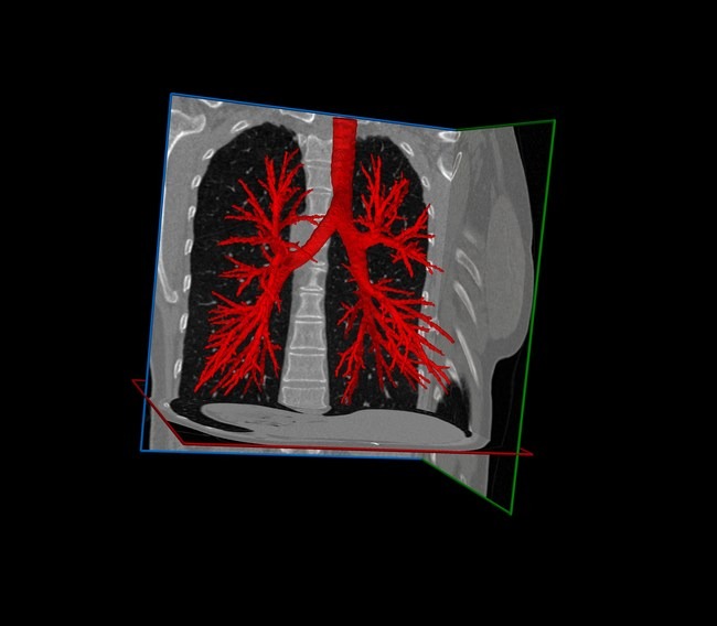 RSIP Vision’s AI technology provides segmentation with better precision for interventional lung procedures