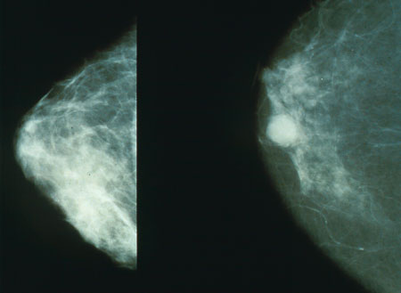 Fujifilm releases Tomosynthesis biopsy option for ASPIRE Cristalle Mammography System