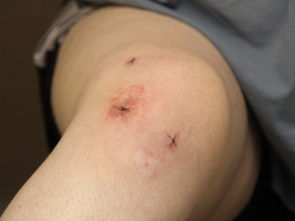 Typical_arthroscopic_surgery_incisions_-_knee