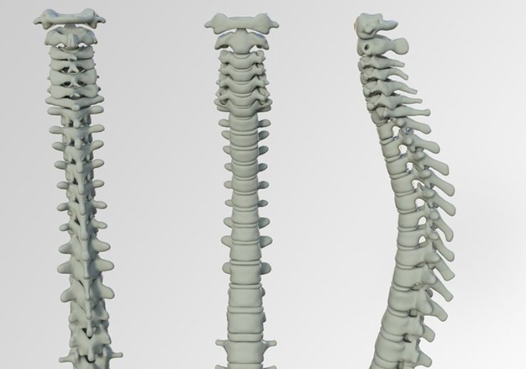 Camber Spine Technologies announces first implantation of SPIRA-O Open Matrix OLIF