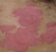 Psoriasis awareness month: Profiling the latest treatment methods to prevent the disease